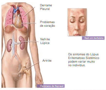 Lupus - S.O.S Medicos - Taviclinica